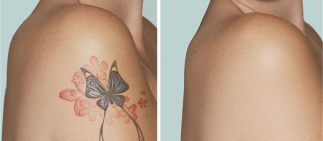 Laser tattoo removal: is it risky or not?
